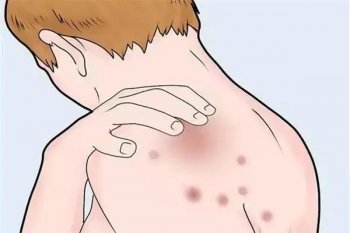 南京皮肤病研究所湿疹咨询指南