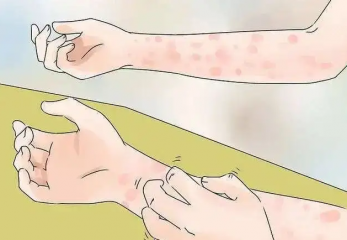 过敏一般多久才会好